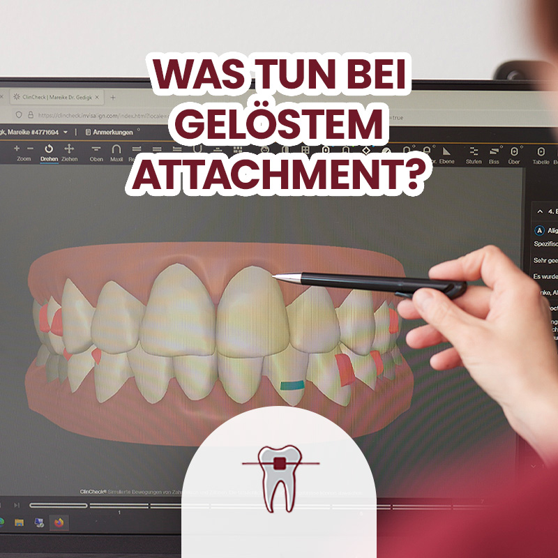Alignerbehandlung, Bildschirm, Attachments, Erläuterung von Dr. Gedigk