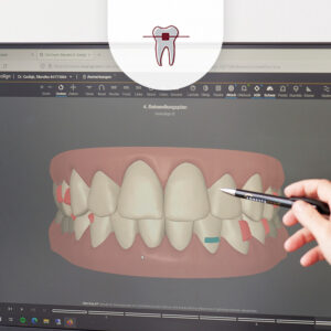 Aligner-Therapie, digitale Planung der Behandlung
